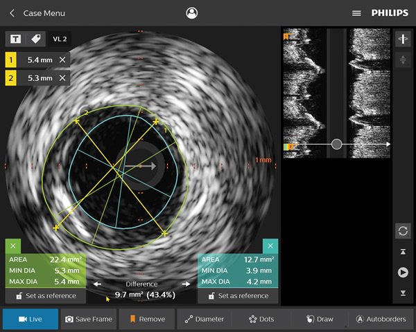 Coronary imaging catheters