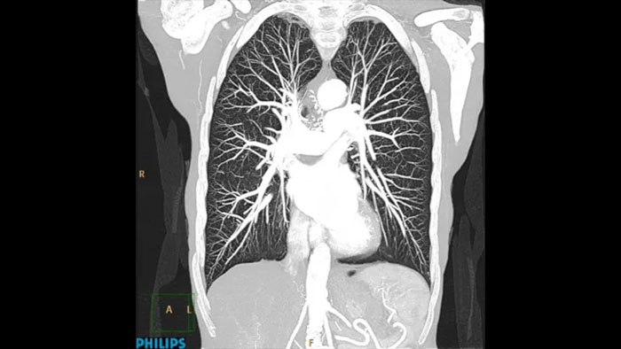 iDose⁴ Reconstruction algorithm | Philips