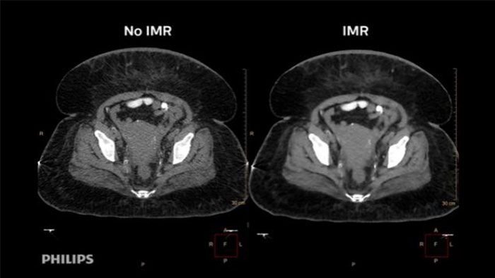 Iterative Model Reconstruction Reconstruction technology | Philips