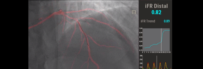 Dynamic Coronary Roadmap